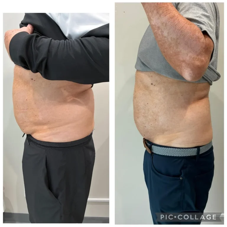T-Shape 2 body contouring before and after - kalon Dermatology Brooklyn